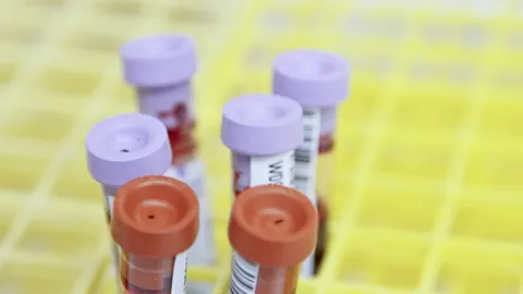 C-peptid viser hvor mye insulin kroppen lager selv.